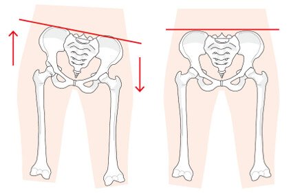 骨盤のバランスの崩れ