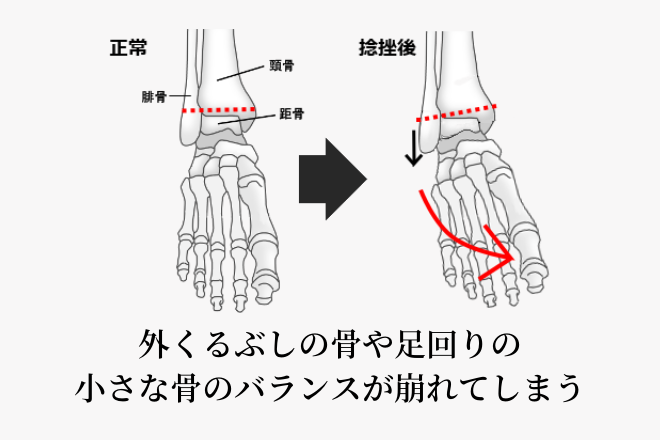 外くるぶしの骨や足首周りの小さな骨のバランスが崩れてしまう