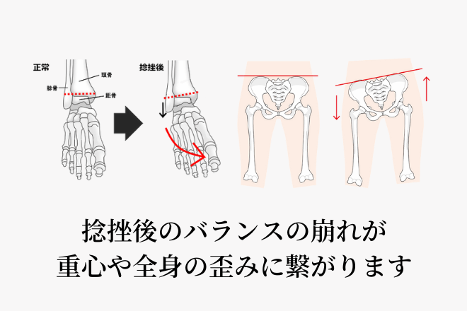 捻挫後のバランスの崩れが重心や全身の歪みに繋がります