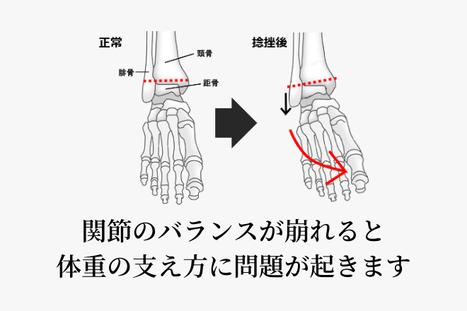 関節のバランスが崩れると体重の支え方に問題が起きます