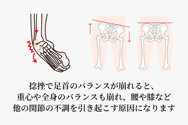 捻挫で足首のバランスが崩れると、重心や全身のバランスも崩れ、腰や膝など他の関節の不調を引き起こす原因になります