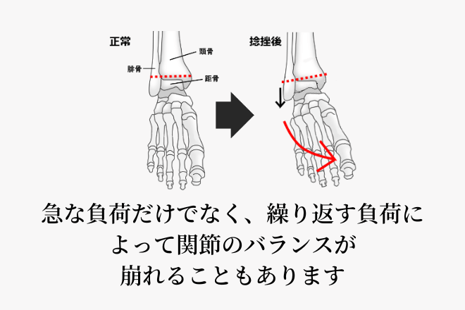 急な負荷だけでなく、繰り返す負荷によって関節のバランスが崩れることもあります