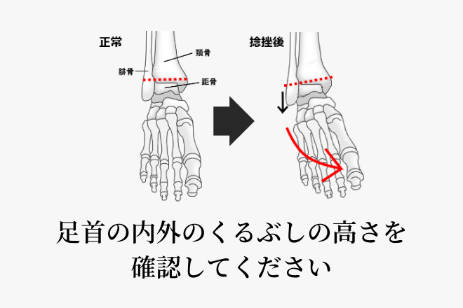 足首の内外のくるぶしの高さを確認してください