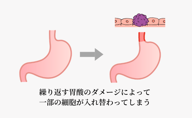 バレット食道とは？