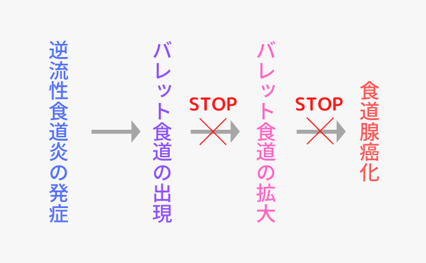 逆流性食道炎から食道腺癌への悪化の流れと、止めることの大切さ