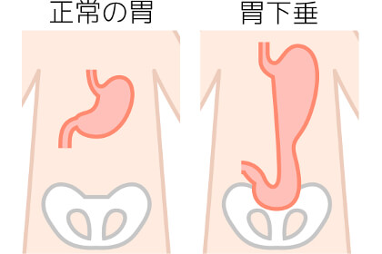 胃下垂のイメージ画像