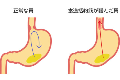 食道括約筋が緩んだ状態との比較