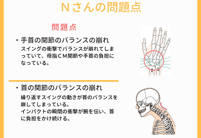 Ｎさんの母指ＣＭ関節症の原因