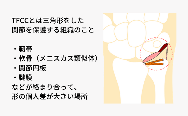 ゴルフでtfcc損傷になってしまう原因と その対策とは 大阪の整体 創輝鍼灸整骨院