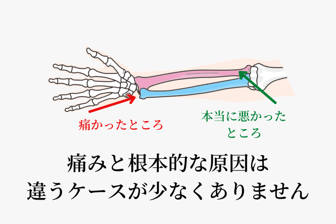 痛みを感じる場所と根本的な原因は一致しないことが珍しくありません