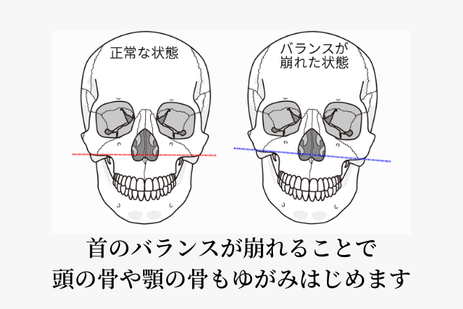 首のバランスが崩れることで頭の骨や顎の骨もゆがみはじめます