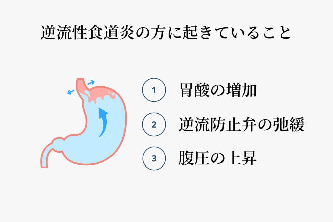 逆流性食道炎を悪化させる原因。食事の量や回数、取っている油やお肉の量、アルコール、タバコの嗜好、炭酸飲料、肥満、ストレス、自律神経の乱れ、運動不足、睡眠不足など