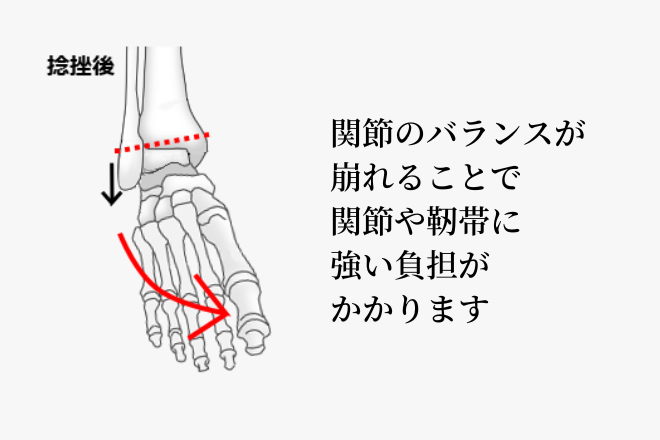 関節のバランスが崩れることで関節や靭帯に強い負担がかかります