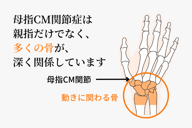 母指ＣＭ関節症は親指だけでなく、多くの骨が、深く関係しています