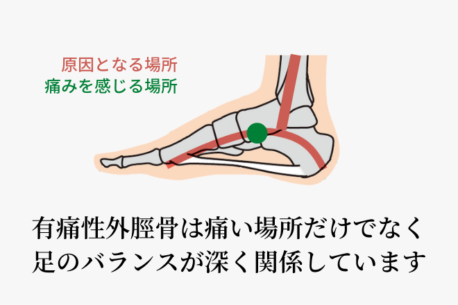 有痛性外脛骨は痛い場所だけでなく足のバランスが深く関係しています
