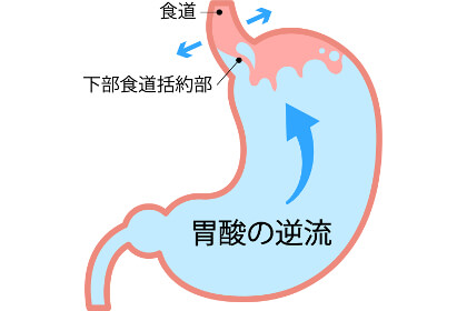 胃酸過多によって逆流する胃のイラスト
