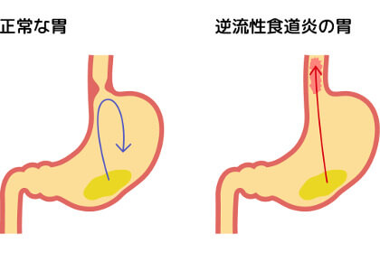 正常な胃と逆流性食道炎の胃の比較