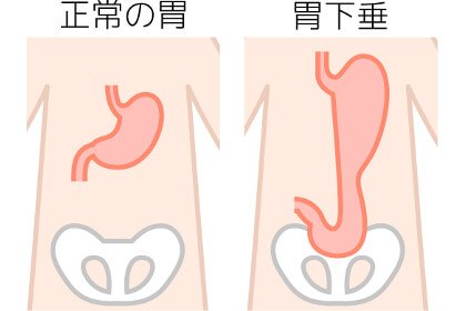 胃が下垂した状態の画像