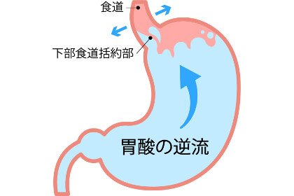 胃下垂による胃酸の分泌過剰