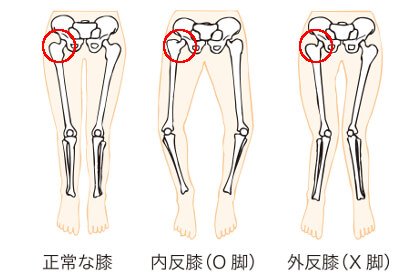 股関節によるＯ脚やＸ脚の影響