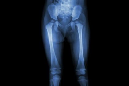 骨盤から膝までのレントゲン写真