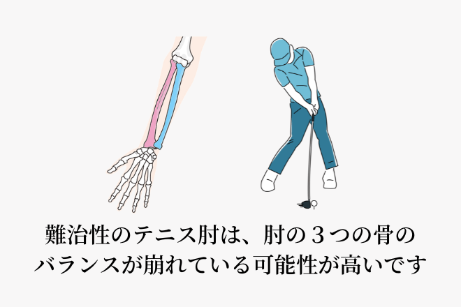 難治性のテニス肘は、肘の３つの骨のバランスが崩れている可能性が高いです