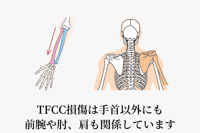 TFCC損傷は手首以外にも前腕や肘、肩も関係しています