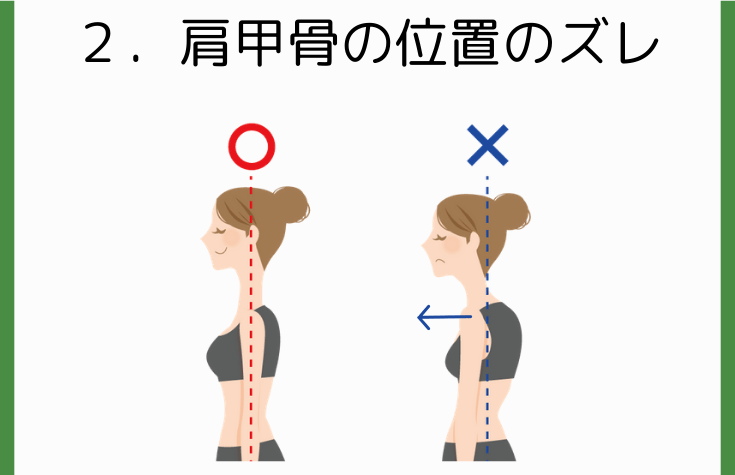 ２．手の使い過ぎによる肩甲骨の位置のズレ